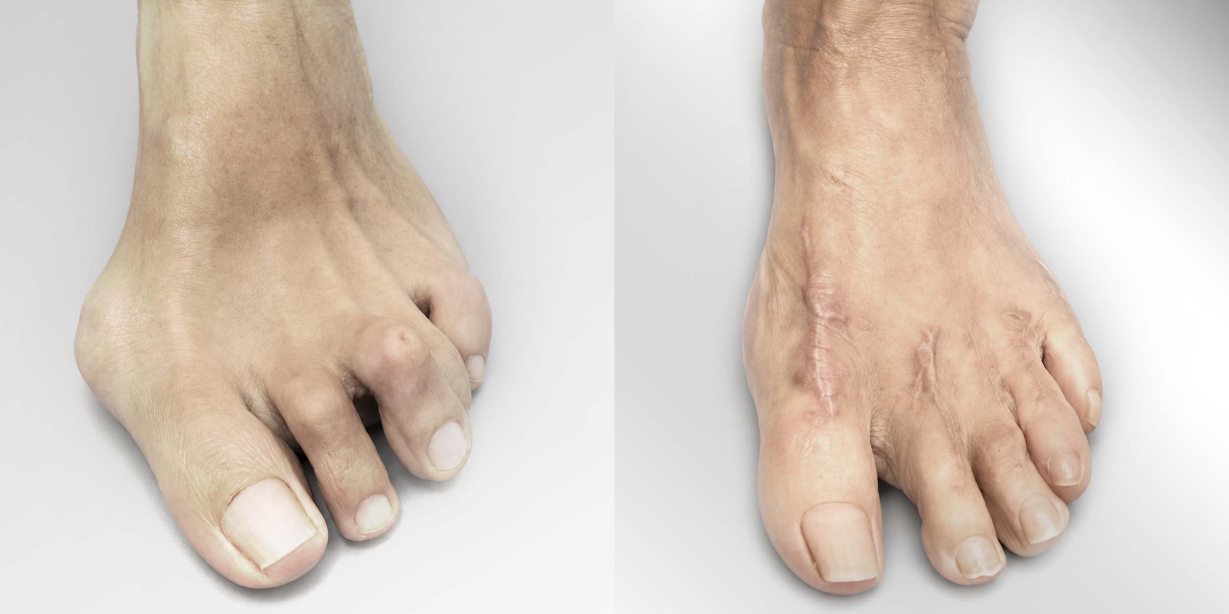 Juanete, Valgus, dedos en garra y heloma dorsal en 3º y 5º dedos