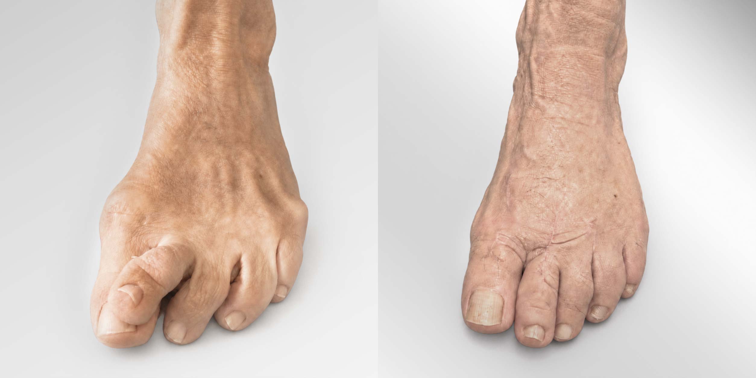 Juanete, Valgus 2º dedo martillo con luxación completa de la articulación metatarsofalángica y metatarsalgia.jpg