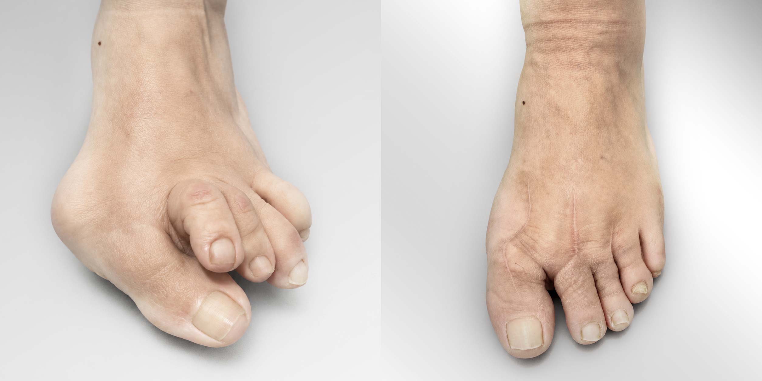 Juanete, dedos martillo con luxación de la articulación metatarsofalangica